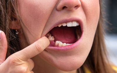 The Impact of a Missing Molar